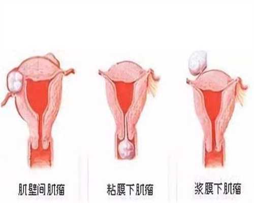广州皇家试管婴儿_印度74岁妇女人工代孕产下双
