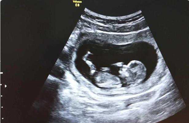 宁波妇儿医院试管 宁波做供卵试管生男孩费用解析 ‘孕妇初期梦到小女孩还有